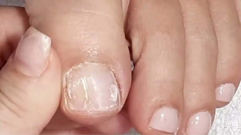 Por que as unhas racham com a idade?